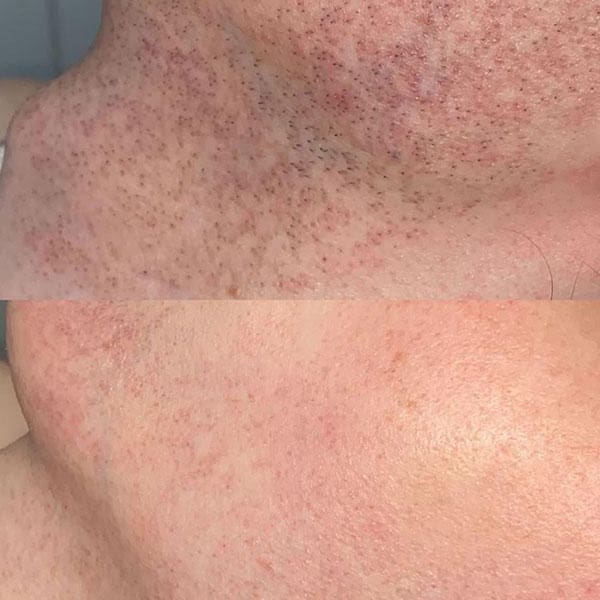laser hair removal - Before and After 1