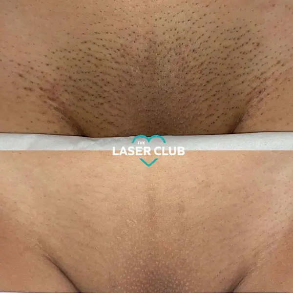 laser hair removal - Before and After 2