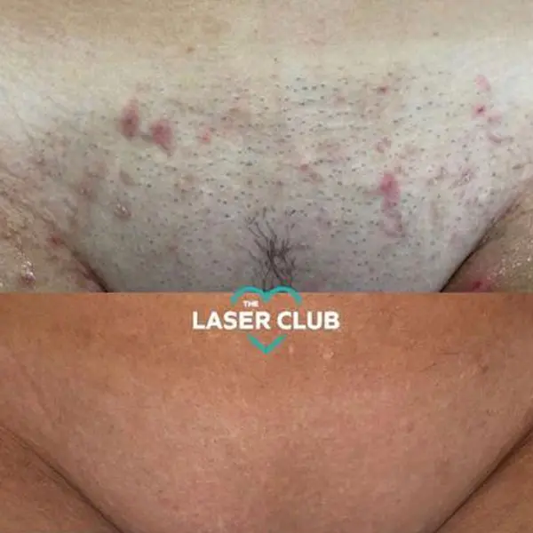 laser hair removal - Before and After 3