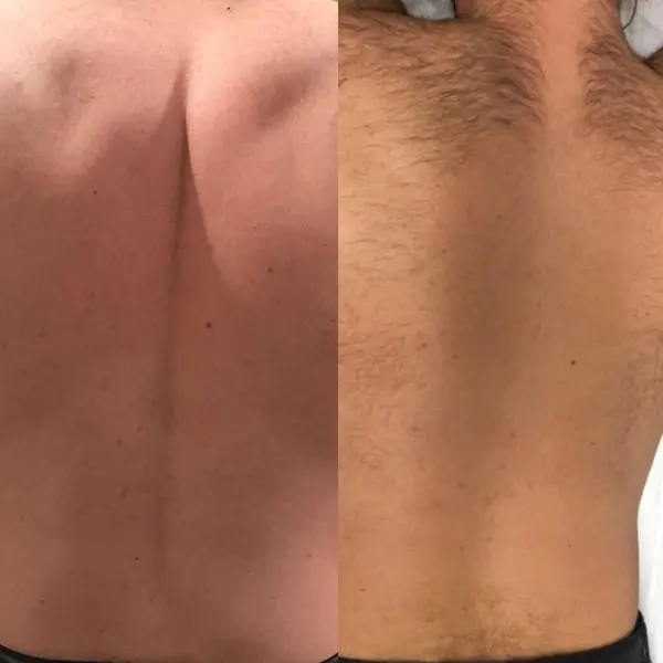laser hair removal - Before and After 4