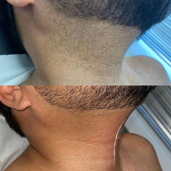 laser hair removal - Before and After 5