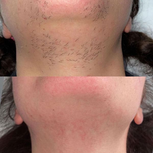 laser hair removal - Before and After 6