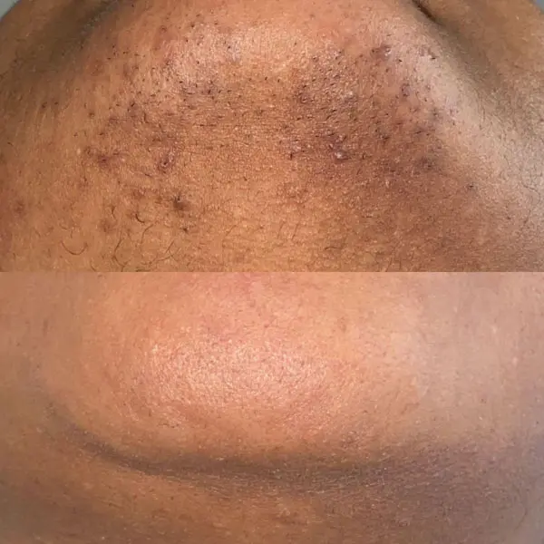 laser hair removal - Before and After 7