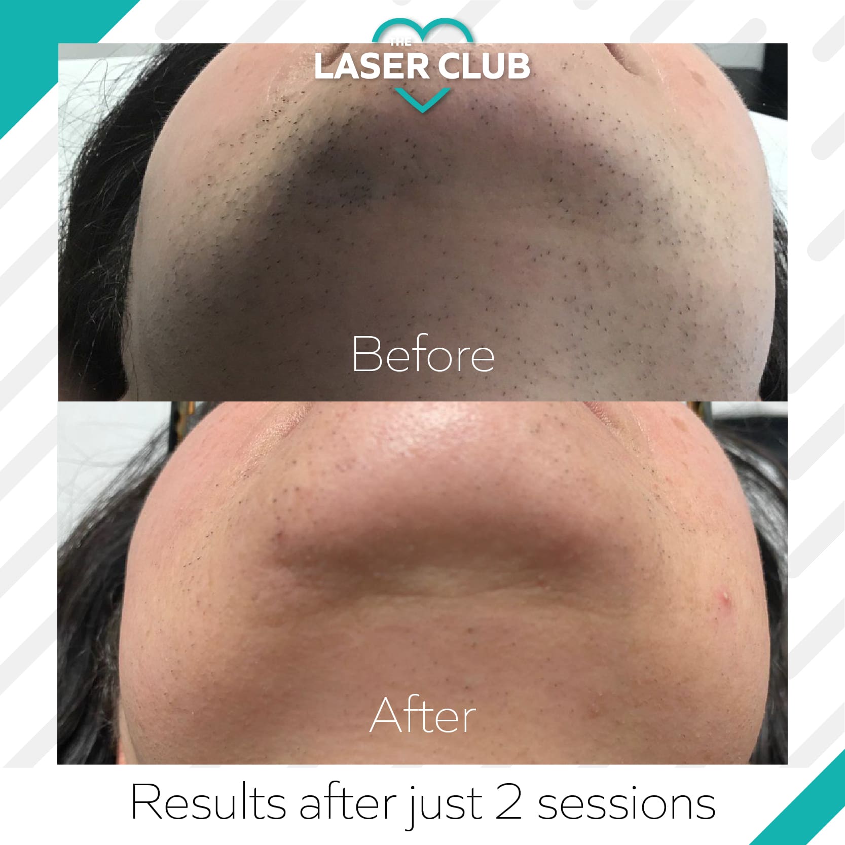 PCOS hair growth how can laser hair removal help? • Laser Club