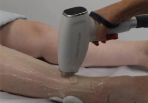 Laser hair removal