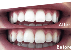 Why Choose Non-Peroxide Laser Teeth Whitening?