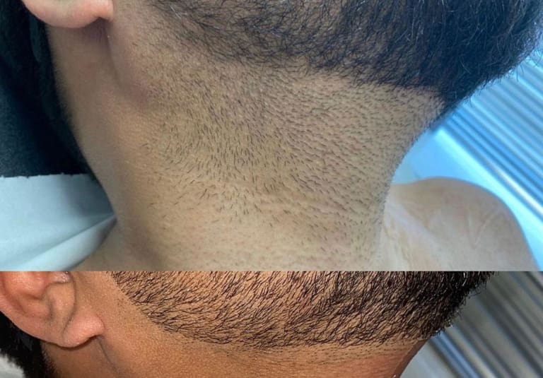 Why Laser Beard Shaping or Full Beard Removal Is Now a Thing!