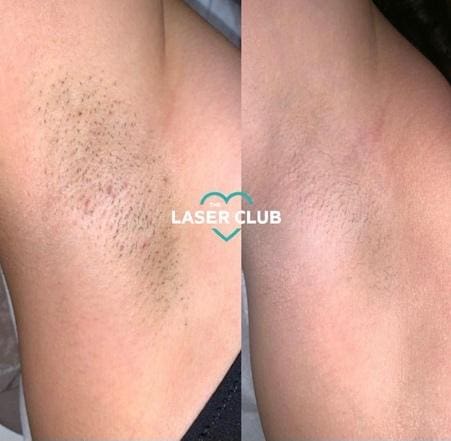 Get Wedding Prep Ready With Laser Hair Removal • Laser Club