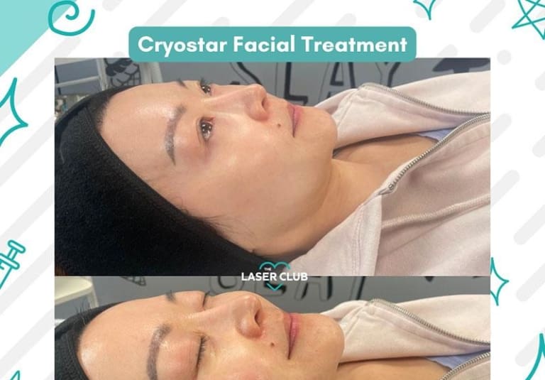 Cryostar Facials VS Injectables Laser Club Cheshire