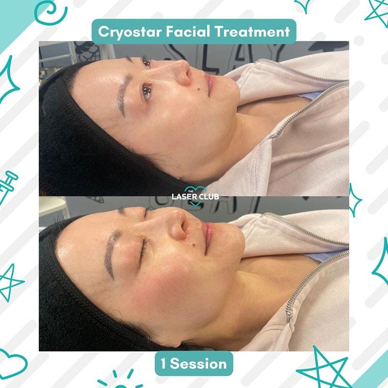 Cryostar Facials VS Injectables for that Snatched Look