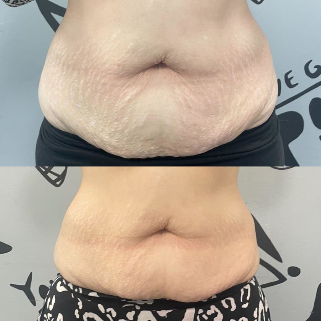 CoolSculpting at The Laser Club