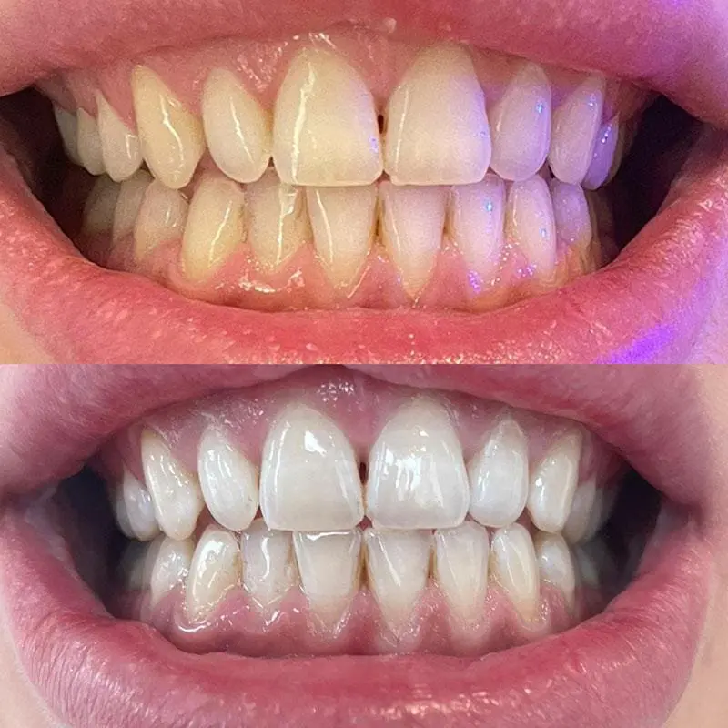 Laser Teeth Whitening vs Home Teeth Whitening • Laser Club