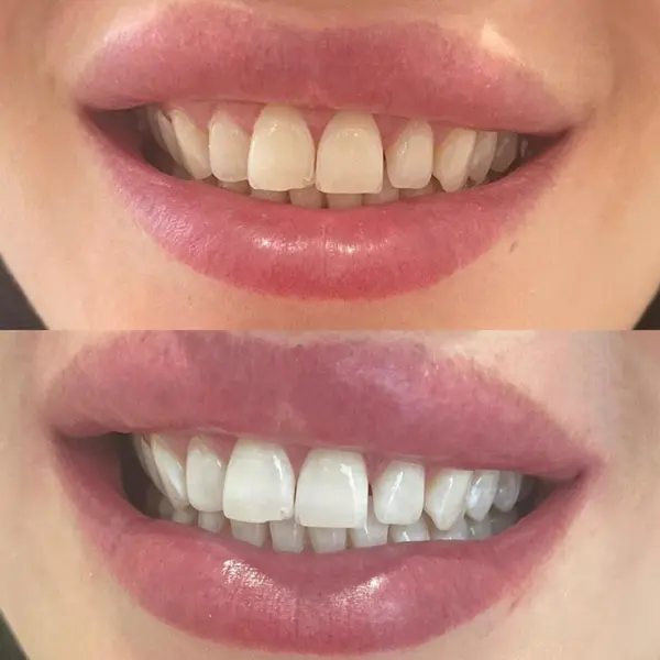 Laser Teeth Whitening vs Home Teeth Whitening Before and After Dublin
