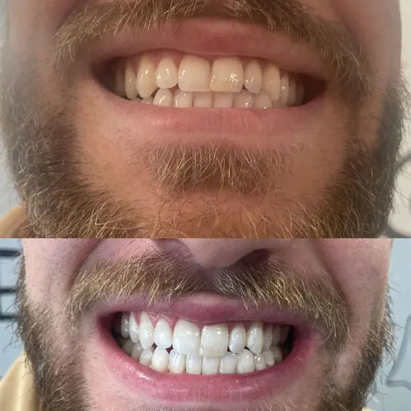 Laser Teeth Whitening vs Home Teeth Whitening Cheshire