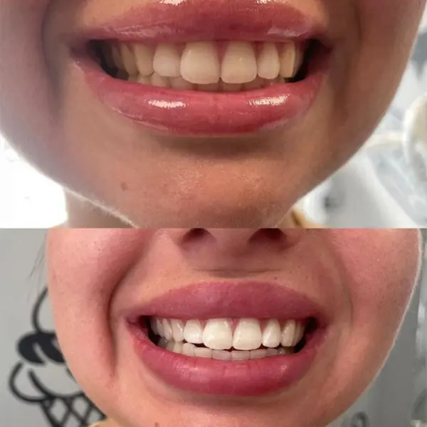 Laser Teeth Whitening vs Home Teeth Whitening Manchester