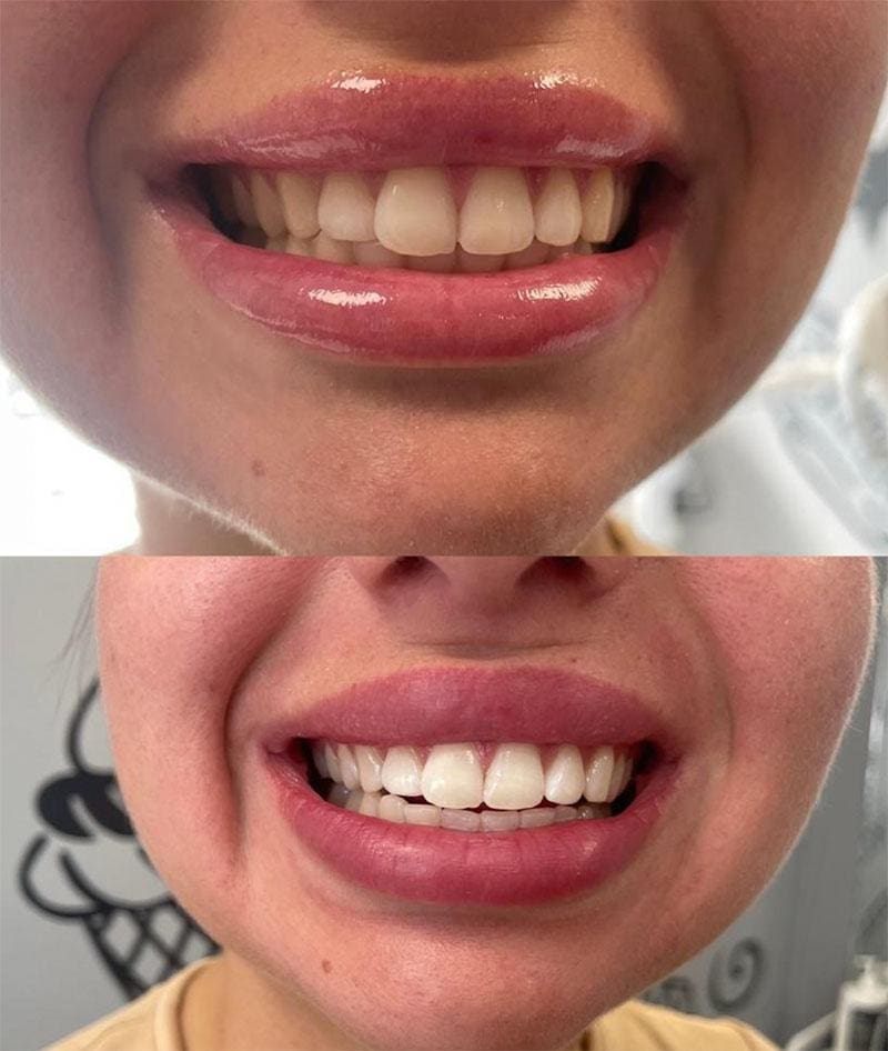Laser Teeth Whitening vs Home Teeth Whitening