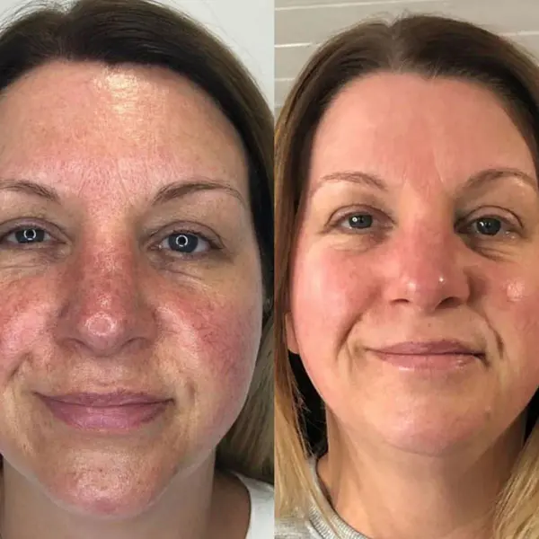 Bespoke Facials - Before and After 1