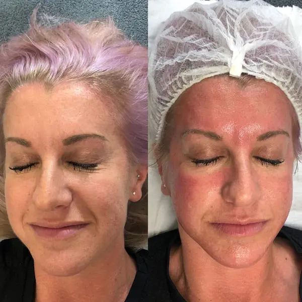Bespoke Facials - Before and After 2