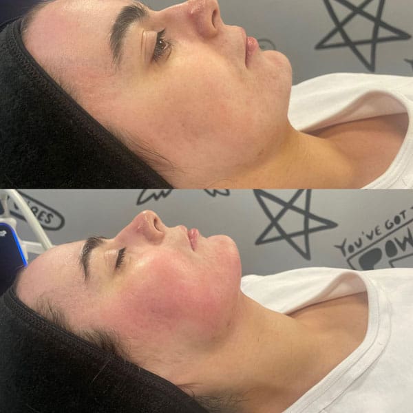 Cryofacial - Before and After 3