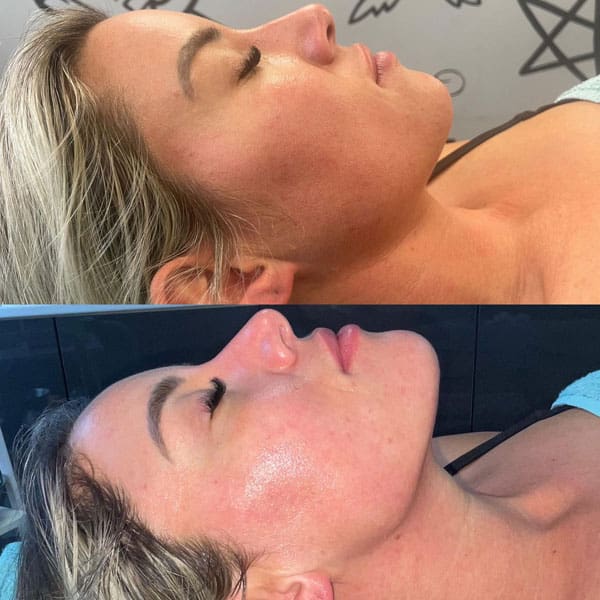 Cryofacial - Before and After 4