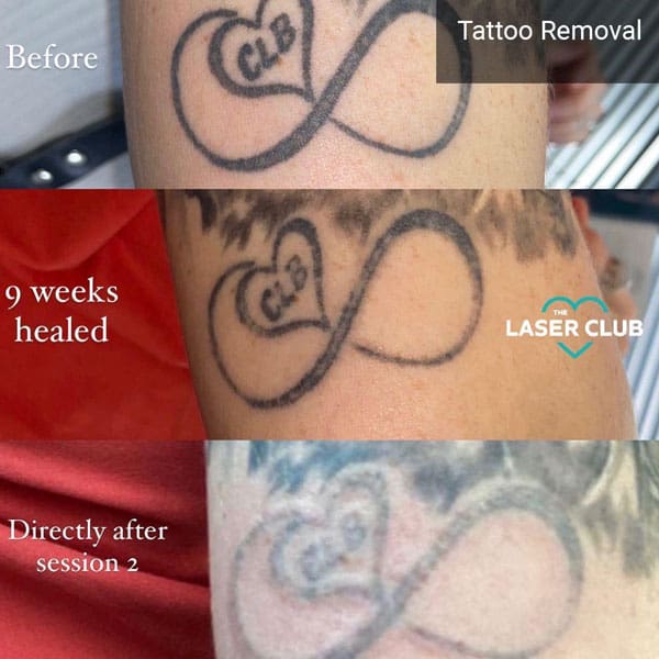 tattoo removal - Before and After 2