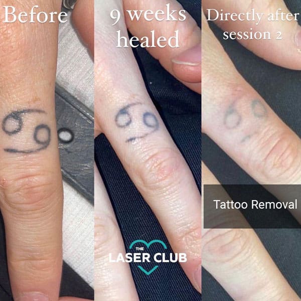 tattoo removal - Before and After 3