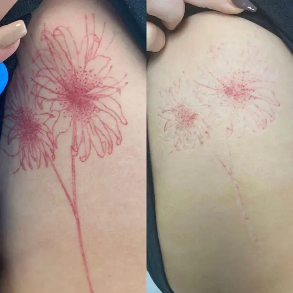 tattoo removal - Before and After 4