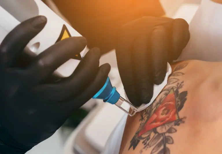 Red Ink Tattoo Removal Leeds