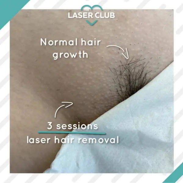 Laser Hair Removal For Women Cheshire