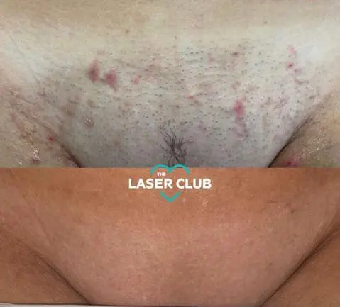 Best Laser Hair Removal Manchester