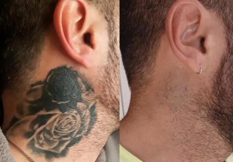 Laser Tattoo Removal Chicago, Il | Costs Tattoo Removal | Bella Sana