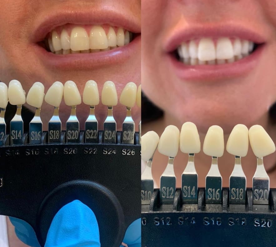 Laser Teeth whitening 2
