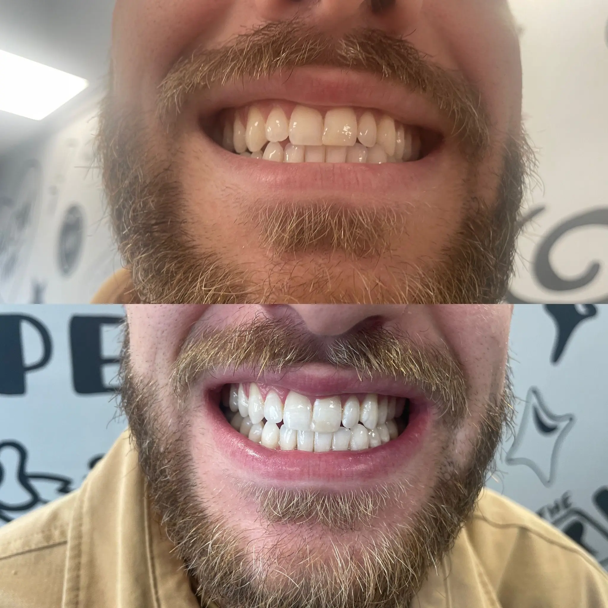 laser teeth whitening