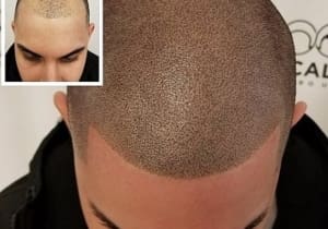 Good example of scalp micro pigmentation