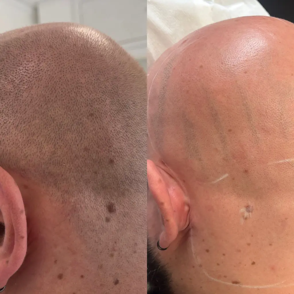 4 sessions of scalp laser hair removal