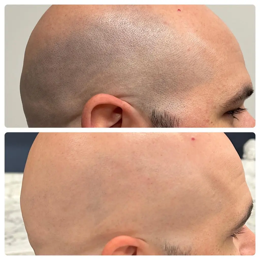 Total before and after on scalp laser hair removal. 8 sessions. 