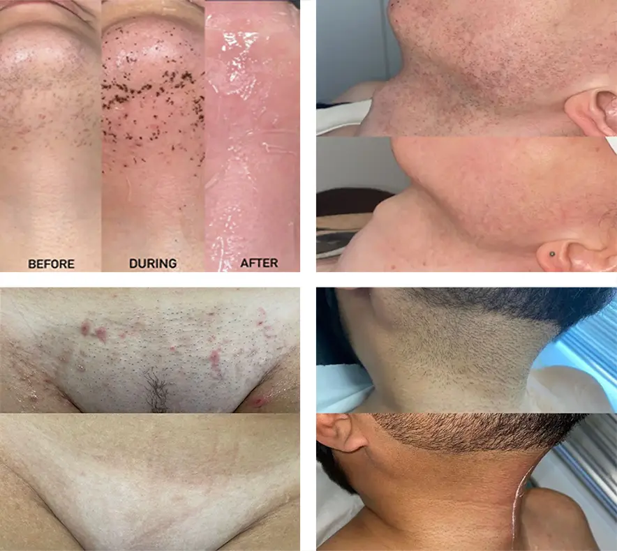 laser hair removal dublin before and after images