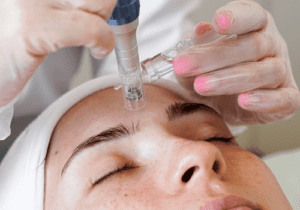 Needle Vs the Knife – Why Micro-needling Is The Best Alternative To A Face Lift