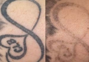 How important is a good machine with Tattoo Removal?