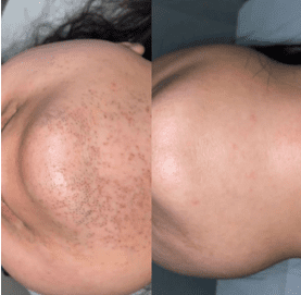 Full course of face laser