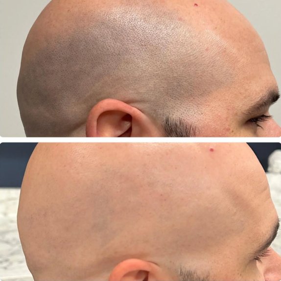 Scalp Laser Hair Removal