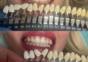 Teeth Whiten – The Laser Club Way