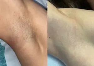 Why has laser hair removal become so popular?