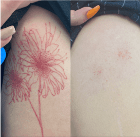 Laser tattoo removal