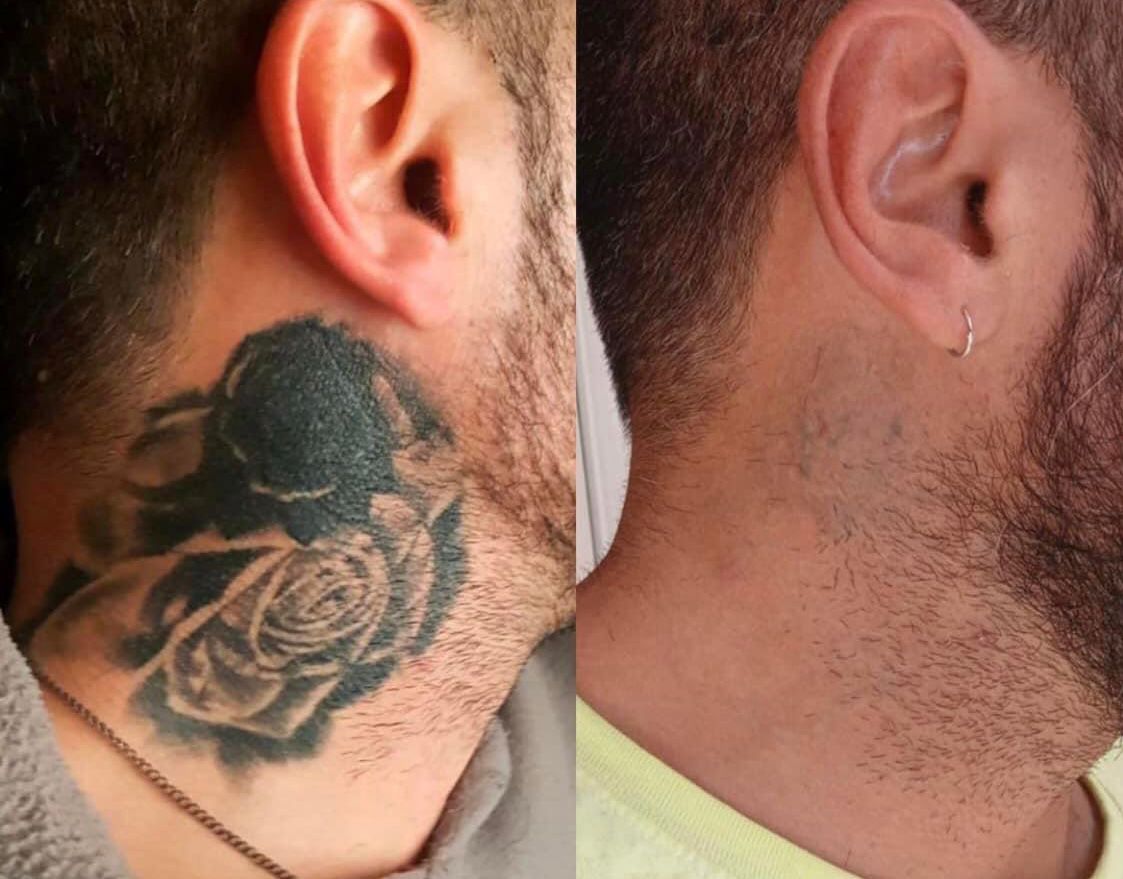 tattoo removal - Before and After 1