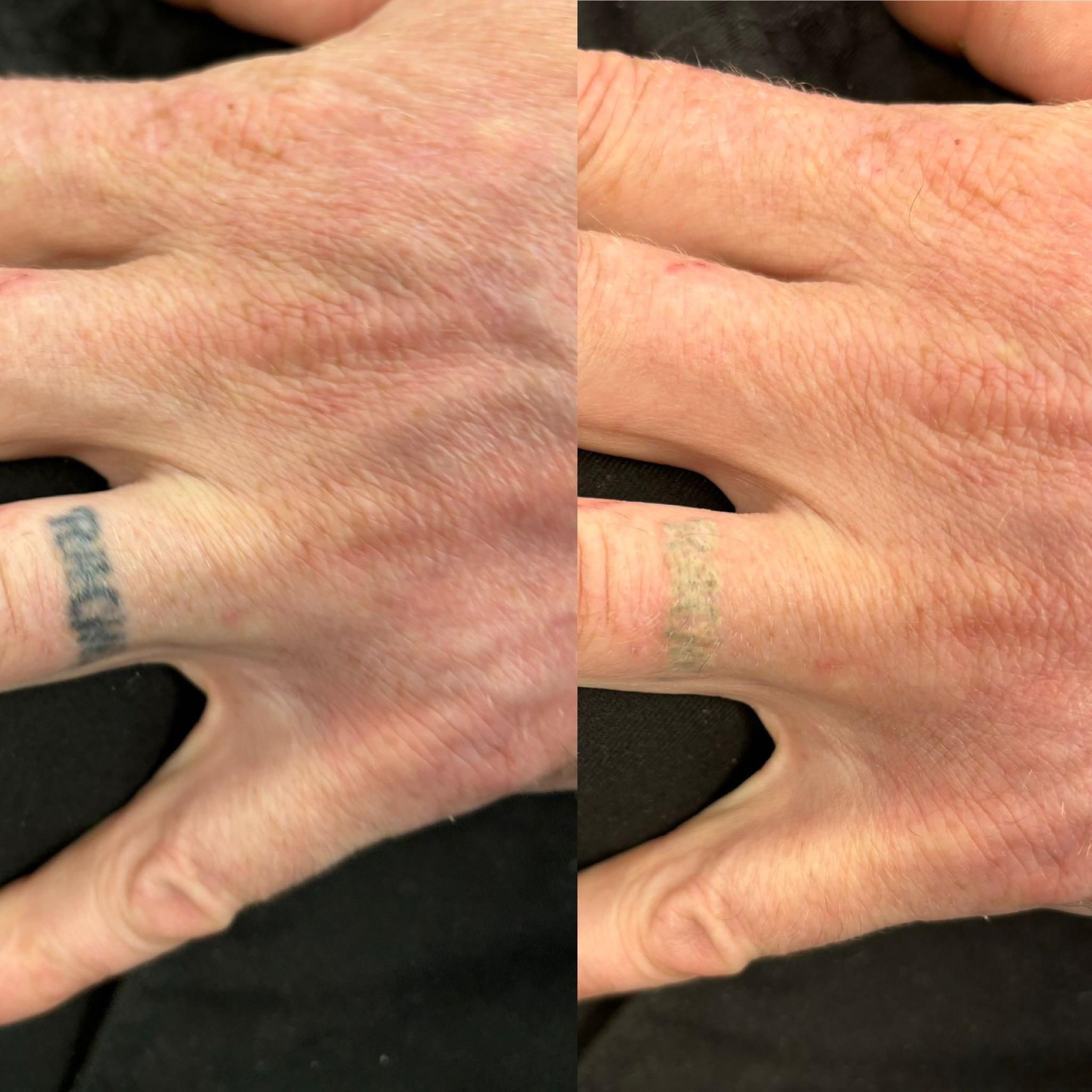 tattoo removal - Before and After 4