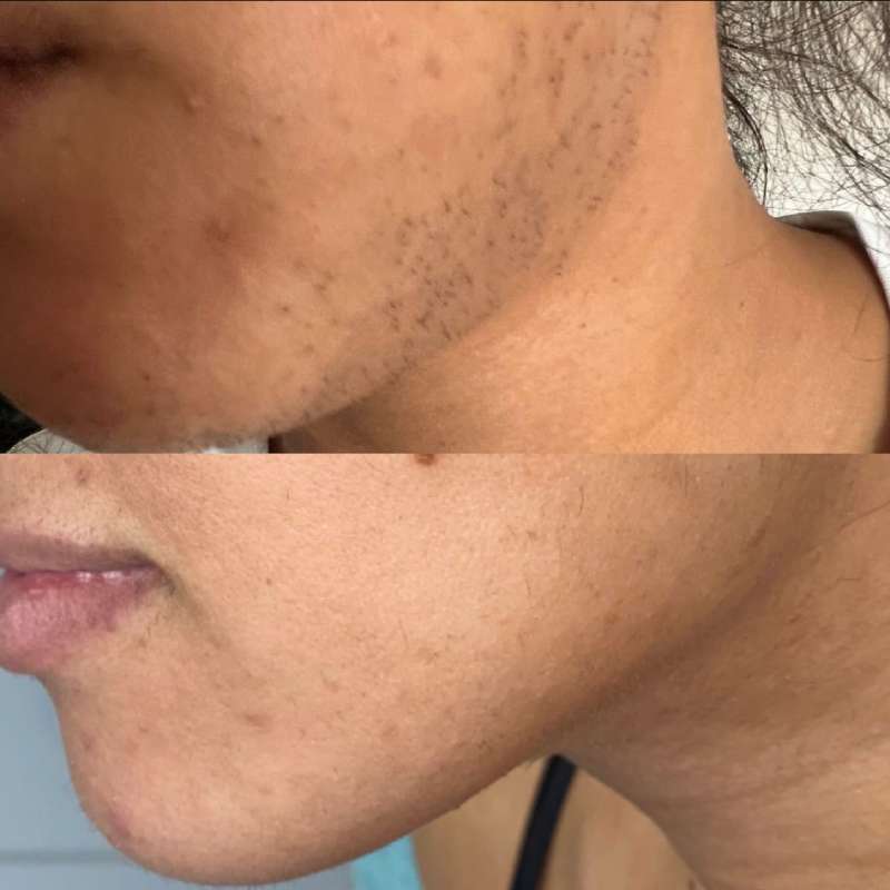 Laser Hair Removal For Dark Skin