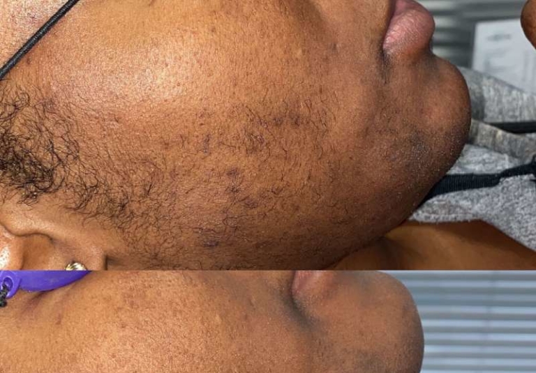 Is Laser Hair Removal Safe For Dark Skin?