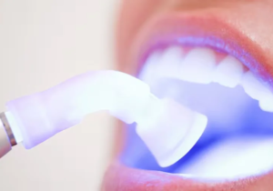 Teeth Whitening Trends in Dublin: What’s Popular Among Locals?