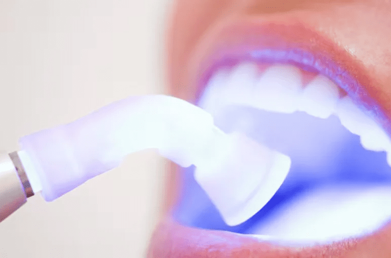 Teeth Whitening Trends in Dublin: What’s Popular Among Locals?